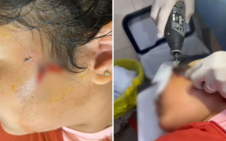 Criança fica com anzol preso no rosto durante pescaria em Luziânia; vídeo